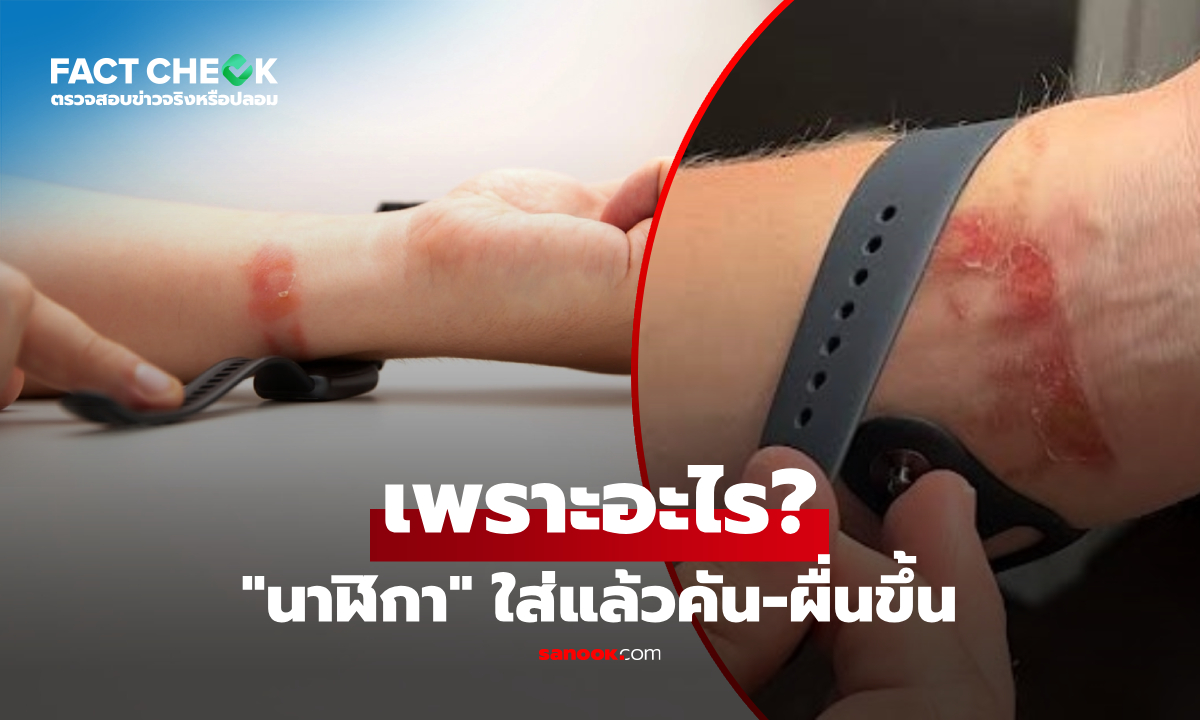 "นาฬิกา" ใส่แล้วคัน-ผื่นขึ้น เป็นเพราะแพ้สายจริงหรือ? เฉลยสาเหตุที่ถูกมองข้าม! : เช็กข่าวชัวร์
