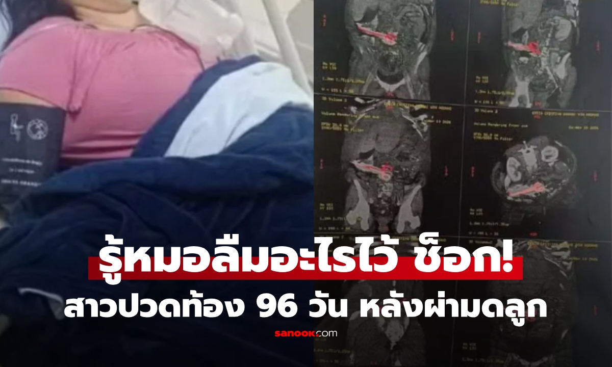 ลืมอะไรไม่ลืม! สาวปวดท้อง 96 วันหลังผ่ามดลูก รู้ต้นเหตุช็อก! หมอลืมของสุดอันตรายไว้