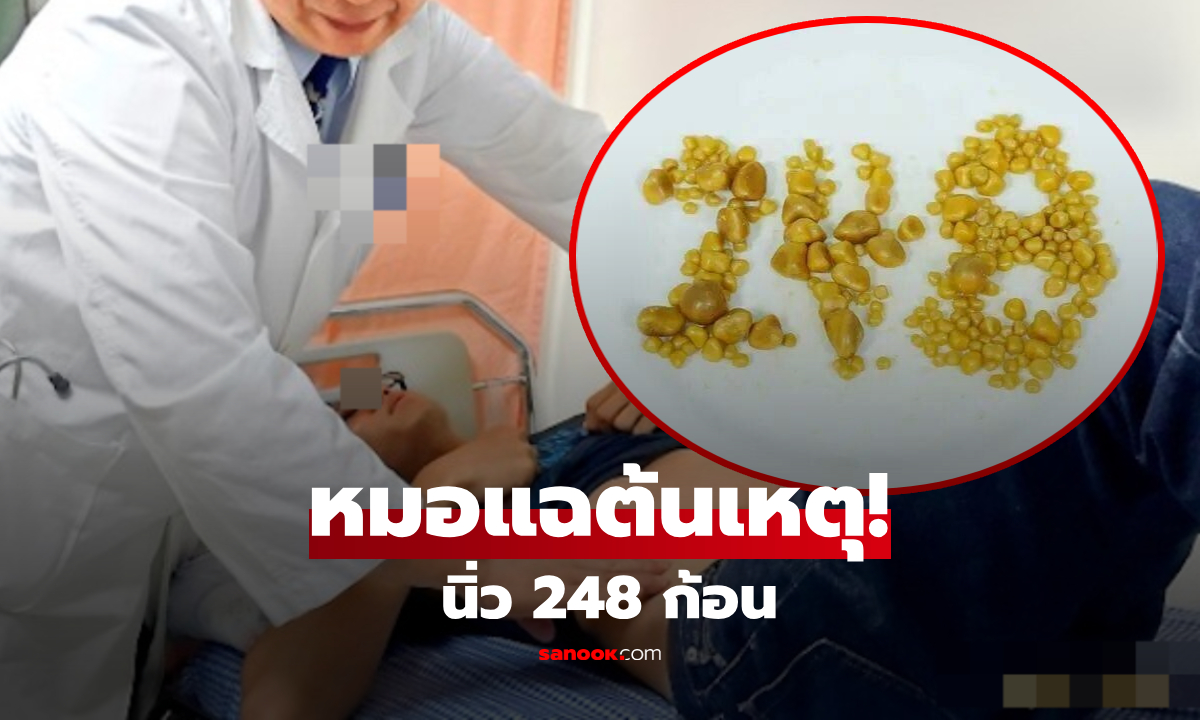 หนุ่มอายุน้อยช็อก! "นิ่วในถุงน้ำดี" 248 ก้อน หลังใช้ชีวิตกินตามใจ ไม่ใช่แค่ข้ามมื้อเช้า