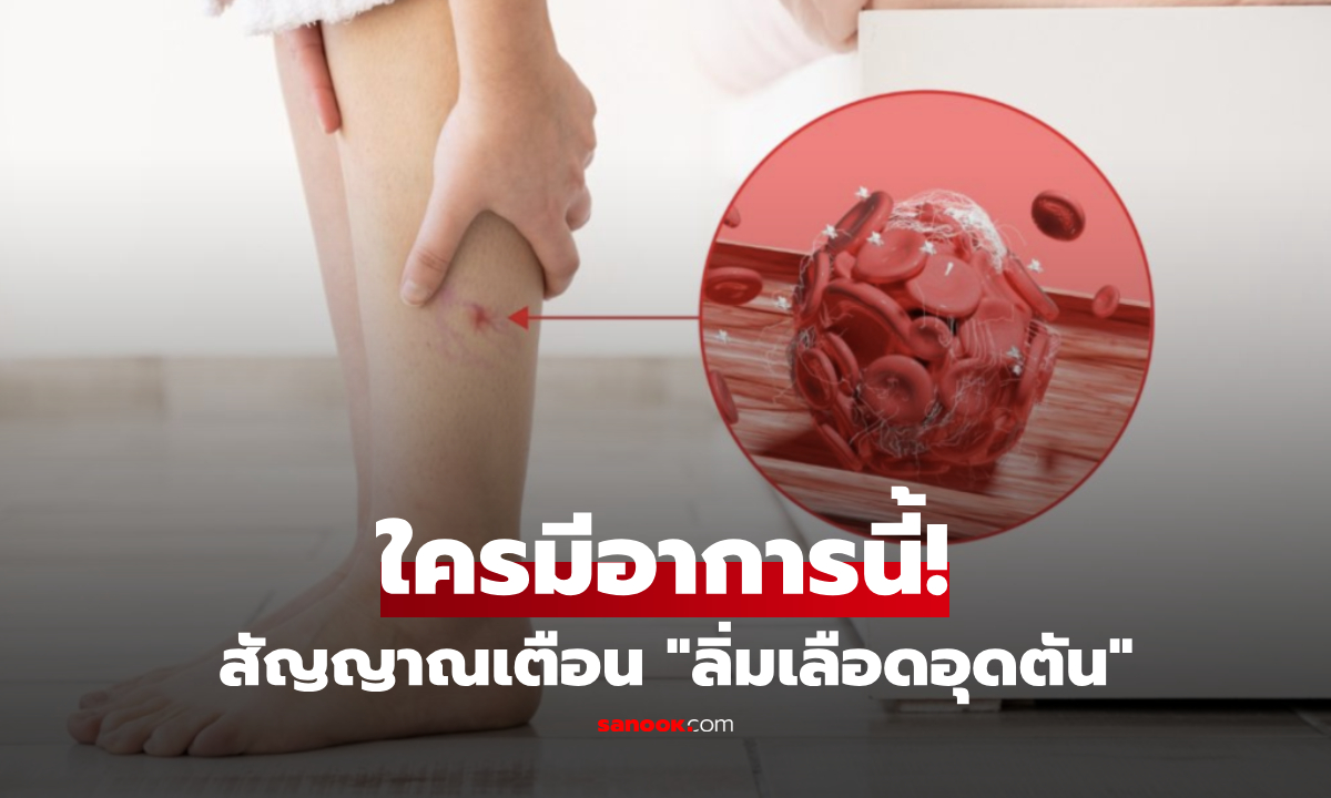 หากขามี "อาการนี้" ระวัง! ลิ่มเลือดอุดตันในร่างกาย ไม่ว่าชายหรือหญิงก็เสี่ยงได้