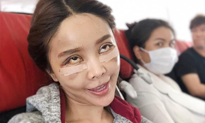 ใจไม่ถึงอย่าดู หญิงแย้ ซูมหน้าเพิ่งศัลยกรรมใหม่ คนทักนึกว่าประสบอุบัติเหตุ